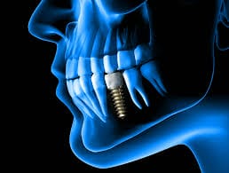 Single dental implant